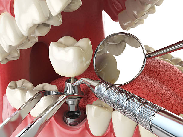 Best Emergency Treatment for Dental Infections or Abscesses in Sandy Valley, NV